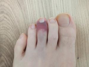 Foot where the middle toe is purple
